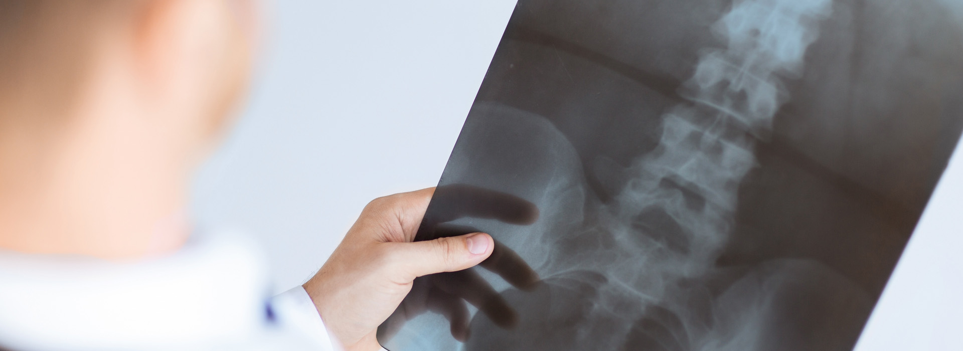 Spinal Cord Injury: Spinal Epidural Abscess